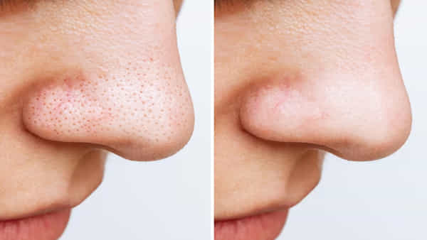 Beauty Tips: ముఖం మీద మచ్చలు, బ్లాక్హెడ్స్తో ఇబ్బంది పడుతున్నారా..? ఇలా పోగొట్టుకోండి..