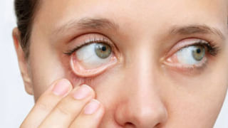 Kidney Stone: ఒంట్లో ఈ విటమిన్‌ లోపించినా కిడ్నీల్లో రాళ్లు పడతాయట.. రాకూడదంటే ఇవి తినాల్సిందే