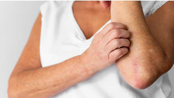 Diabetic Patients: చర్మంపై దురద, దద్దుర్లతో ఇబ్బంది పడుతున్నారా... అది మధుమేహం లక్షణమా?