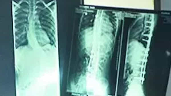 Bangalore: శరీరంలో సర్జికల్ సూది మర్చిపోయిన డాక్టర్లు.. కట్ చేస్తే.. 20 ఏళ్ల తర్వాత భారీ పరిహారం