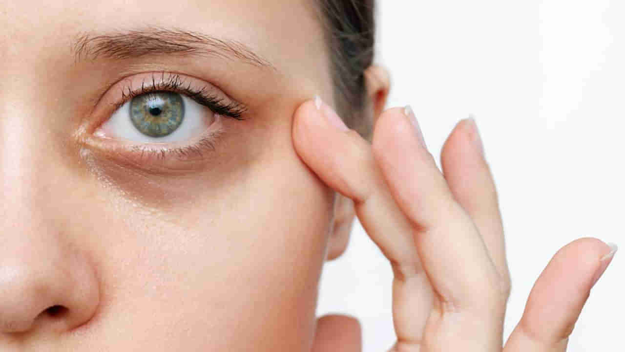 Dark Circles: డార్క్ సర్కిల్స్‌ని పర్మినెంట్‌గా ఎలా దూరం చేయాలనుకుంటున్నారా..? ఇలా ట్రై చేయండి..