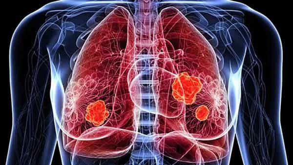 Lung Cancer Vaccine: ఊపిరితిత్తుల క్యాన్సర్కు తొలి వ్యాక్సిన్.. 67 ఏళ్ల రోగిపై ట్రయల్స్!