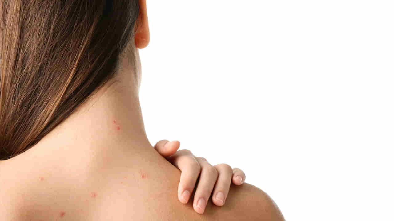 Acne: వీపు, మెడపై మొటిమలతో ఇబ్బంది పడుతున్నారా? ఈ చిట్కాలు ట్రై చేసి చూడండి