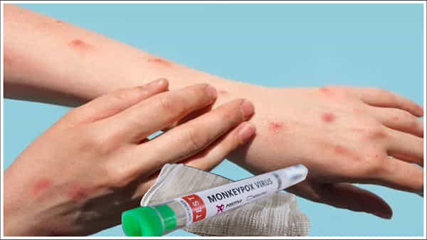 Monkeypox: దుబాయ్ నుంచి వచ్చిన మరో కేరళ వాసికి మంకీపాక్స్ నిర్ధారణ.. క్లాడ్ 1బి వైరస్గా గుర్తింపు