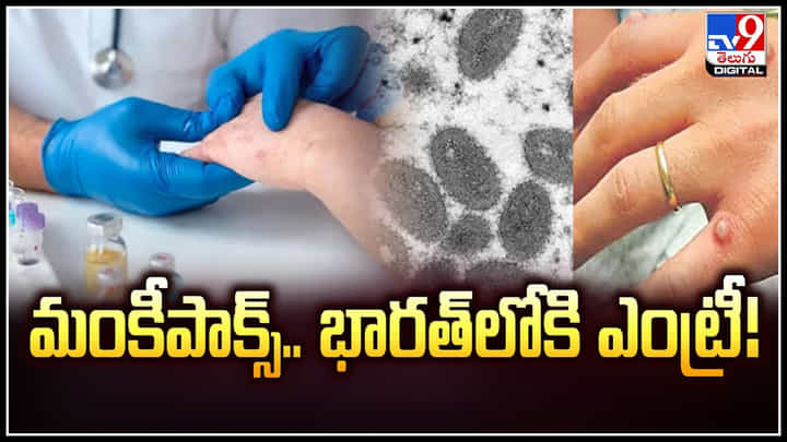 Monkeypox: మంకీపాక్స్ భారత్లోకి ఎంట్రీ.! కరోనా కంటే డేంజర్ గా మంకీపాక్స్.! Monkeypox: మంకీపాక్స్ భారత్లోకి ఎంట్రీ.! కరోనా కంటే డేంజర్ గా మంకీపాక్స్.!