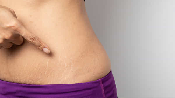 Pregnancy: ప్రెగ్నెన్సీ తర్వాత స్ట్రెచ్ మార్క్ రావొద్దంటే.. ఈ సింపుల్ టిప్స్ పాటించండి