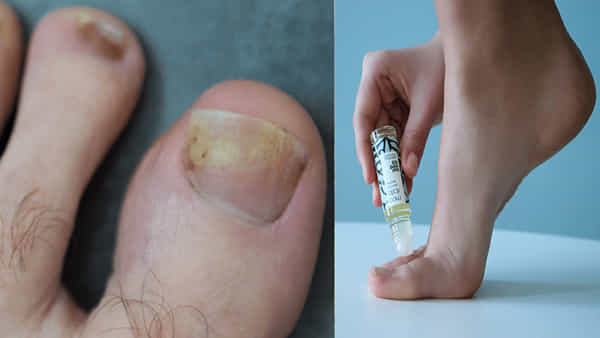 Toenail Fungus: కాలి గోళ్ళలో చీము పేరుకుని పసుపు రంగులోకి మారాయా.. నివారణకు ఈ చిట్కా అప్లై చేసి చూడండి..