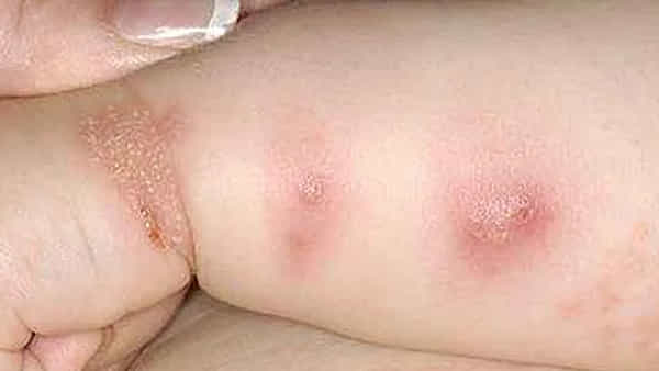 West Nile Virus: ప్రాణాంతక వెస్ట్ నైల్ వైరస్ వ్యాప్తి.. అధికారుల నిర్లక్ష్యం అంటూ సెవిల్లే నివాసితులు నిరసన