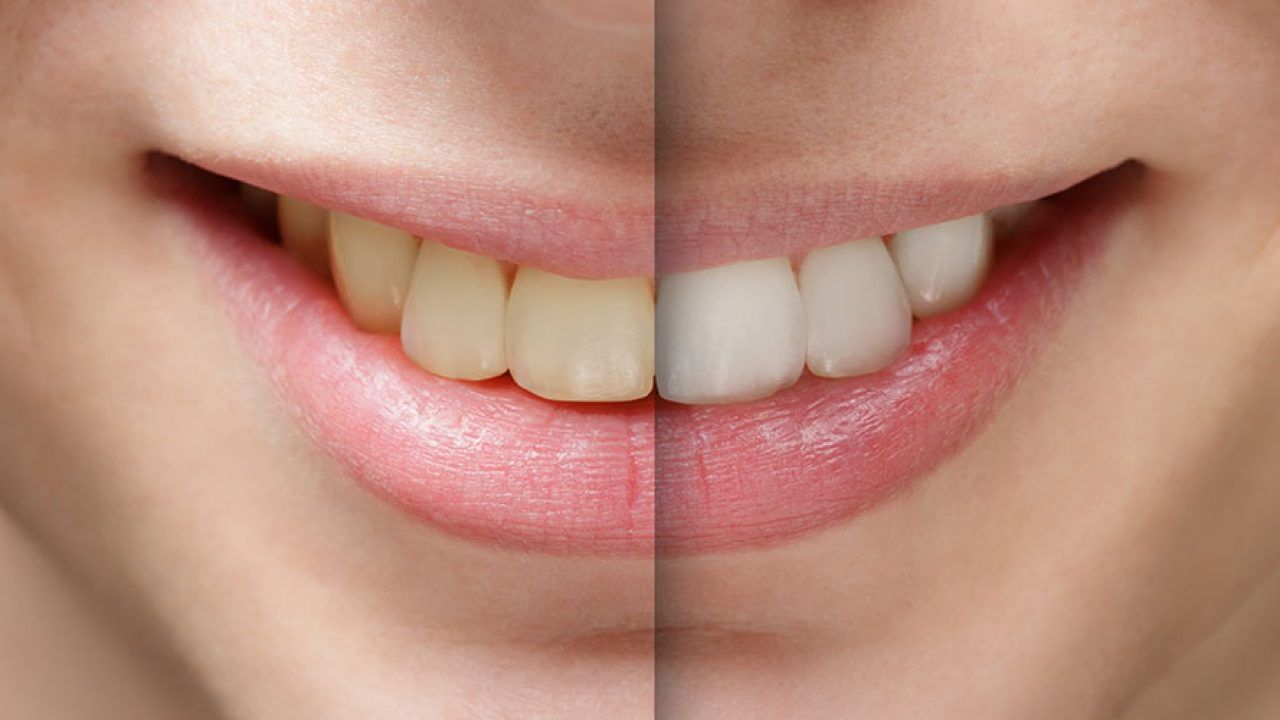 Remedies for Teeth: మీ దంతాలు తెల్లగా మెరిసి పోవాలా.. ఈ చిట్కాలు బెస్ట్!