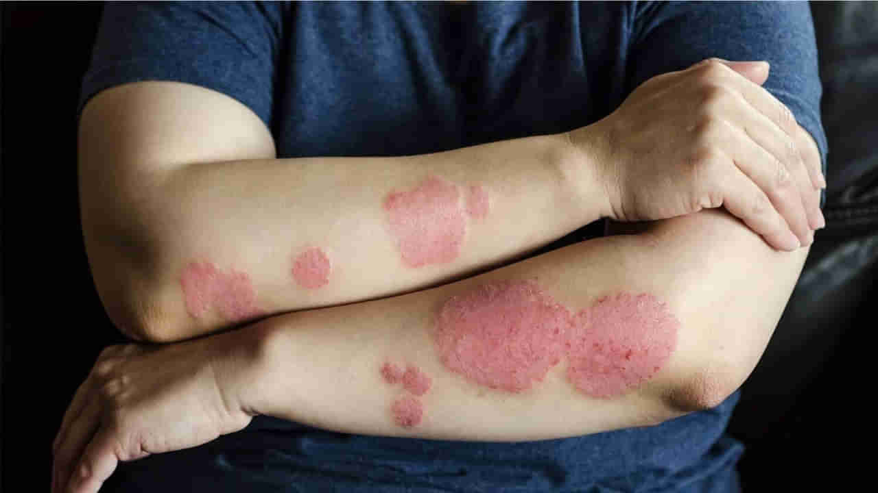 World Psoriasis Day: చర్మంపై దురద, ఎర్రని దద్దుర్లు కనిపిస్తున్నాయా? వెంటనే అలర్ట్‌ అవ్వలేదంటే చిక్కులు తప్పవు