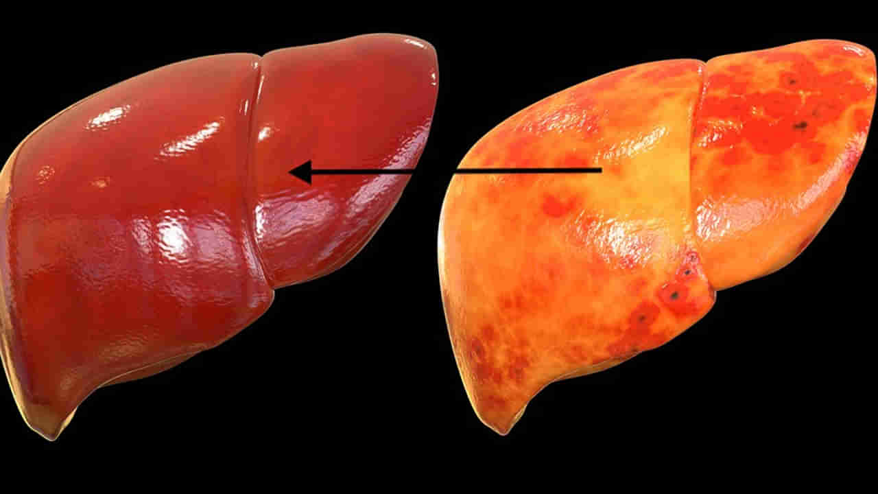 Fatty Liver:  దేశంలో ప్రబలుతున్న ఫ్యాటీ లివర్ డిసీజ్.. ఈ లక్షణాలు ఉంటే డేంజర్‌లో ఉన్నట్లే