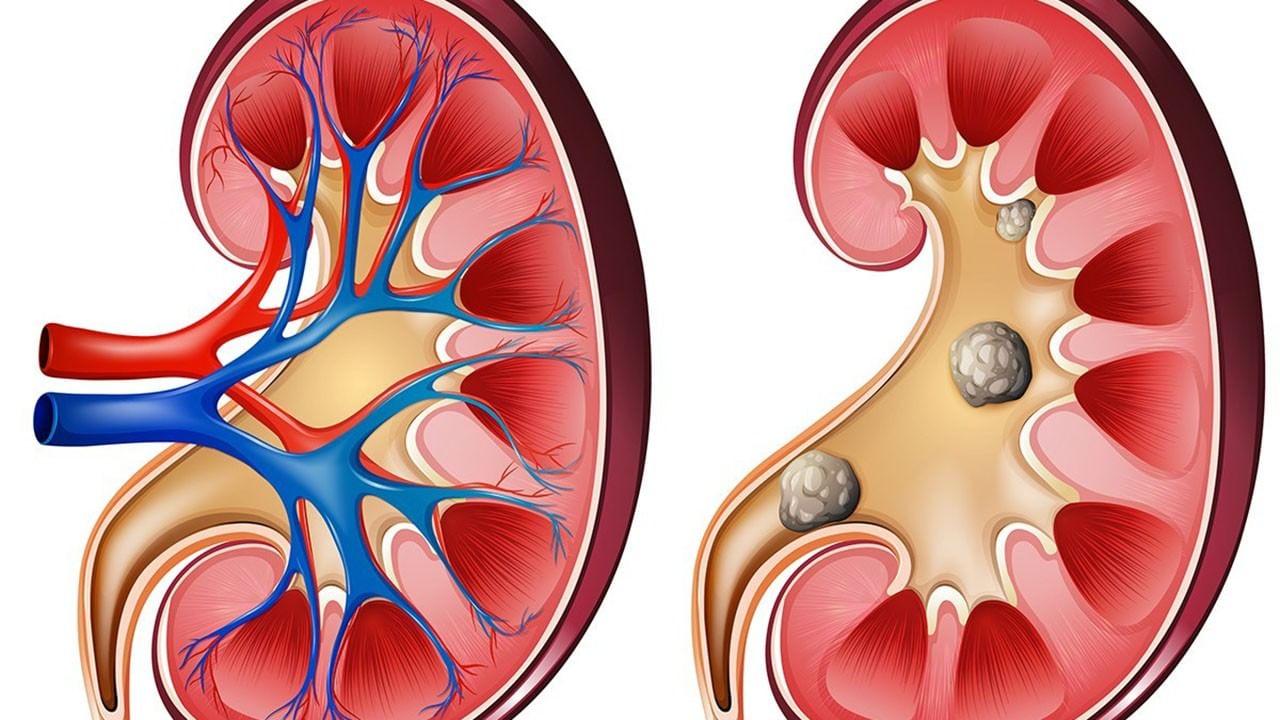 Kidneys Clean 5