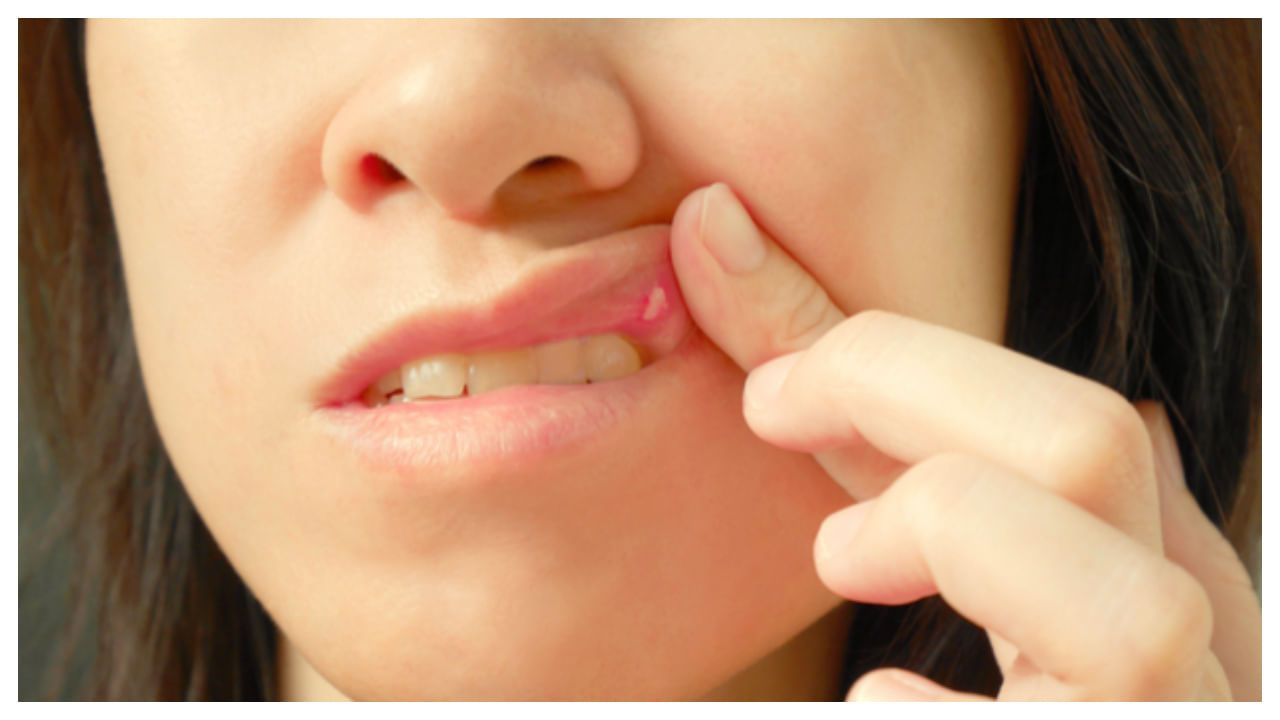 Mouth Ulcers: చలి కాలంలో వచ్చే నోటి పుండ్లు.. ఇలా చెక్ పెట్టండి..