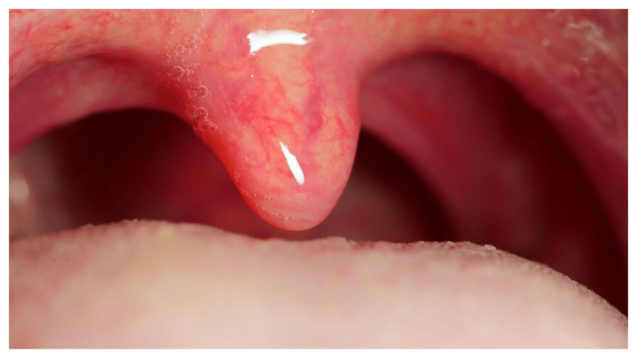 Swollen Uvula: కొండ నాలుక వచ్చిందా.. ఈ టిప్స్‌తో చిటికెలో పోగొట్టవచ్చు..