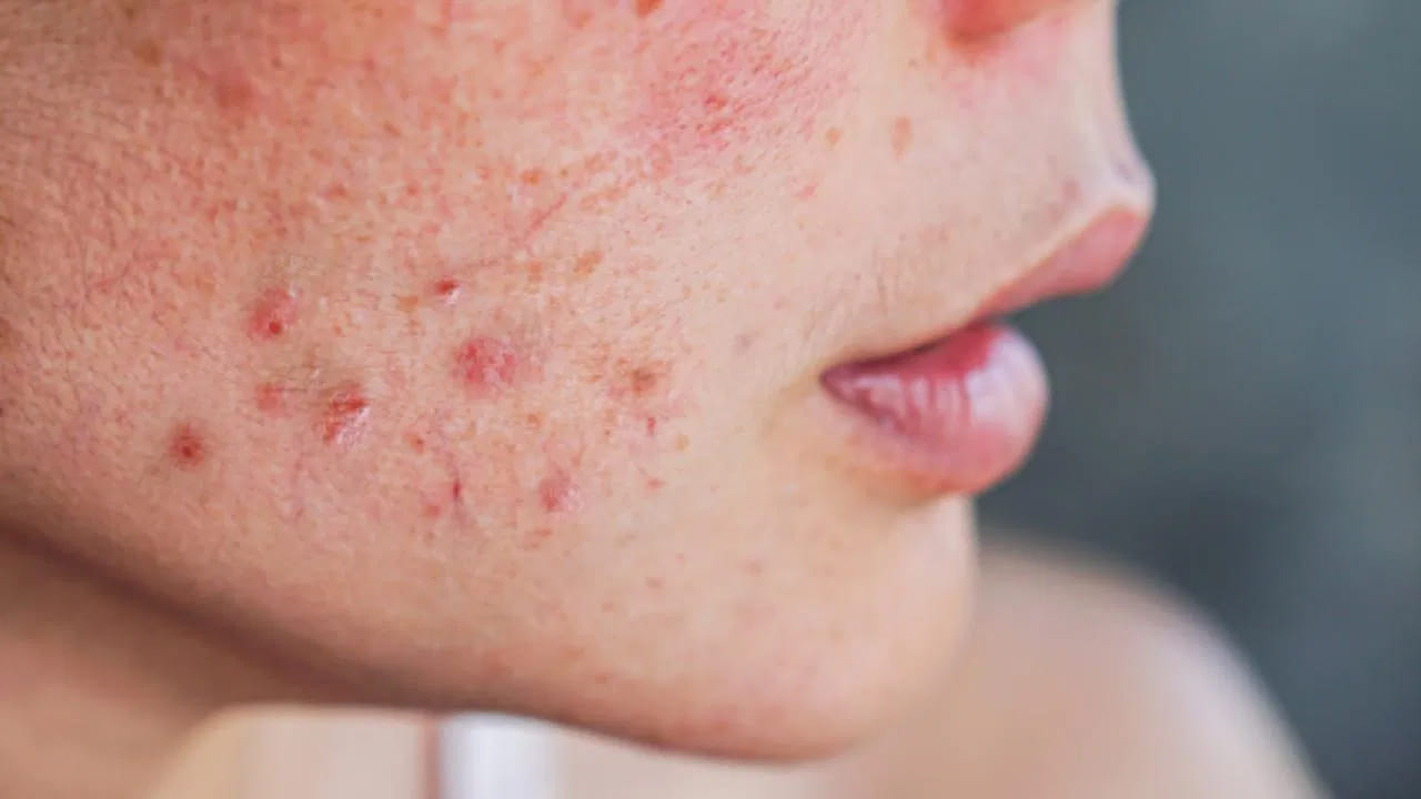 మొటిమలను తొలగించడంలో వేప నీరు సహాయపడుతుంది. ఇందుకోసం ముందుగా వేప ఆకులను తీసుకుని నీటిలో వేసి మరిగించాలి. నీరు మరిగిన తర్వాత, దానిని ఫిల్టర్ చేసి స్ప్రే బాటిల్‌లో నింపుకోవాలి. ఈ వేప నీటిని రోజుకు మూడు సార్లు ముఖంపై పిచికారీ చేస్తే సరి. మొటిమలు రానేరావు.