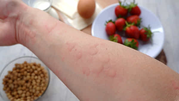 Health: అసలు ఫుడ్ అలర్జీ ఎందుకు వస్తుంది.? ఎలాంటి లక్షణాలు కనిపిస్తాయి..
