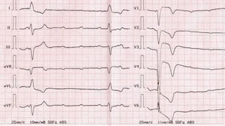 Japanese Encephalitis: మరో ప్రాణాంతక వైరస్‌! మెదడుకి జ్వరం.. ఆ వెంటనే మరణం.. తస్మాత్‌ జాగ్రత్త