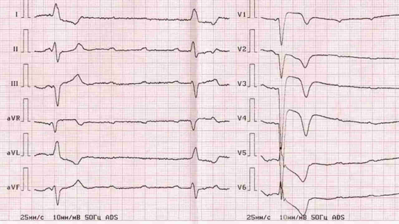 Heart Helath: కార్డియాక్ అరెస్ట్‌కు, హార్ట్ అటాక్‌కూ మధ్య తేడా ఏంటి?