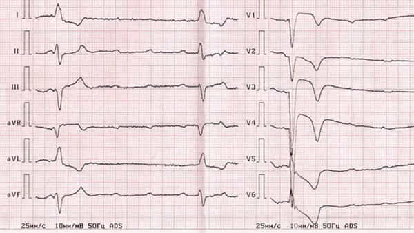 Heart Helath: కార్డియాక్ అరెస్ట్కు, హార్ట్ అటాక్కూ మధ్య తేడా ఏంటి?