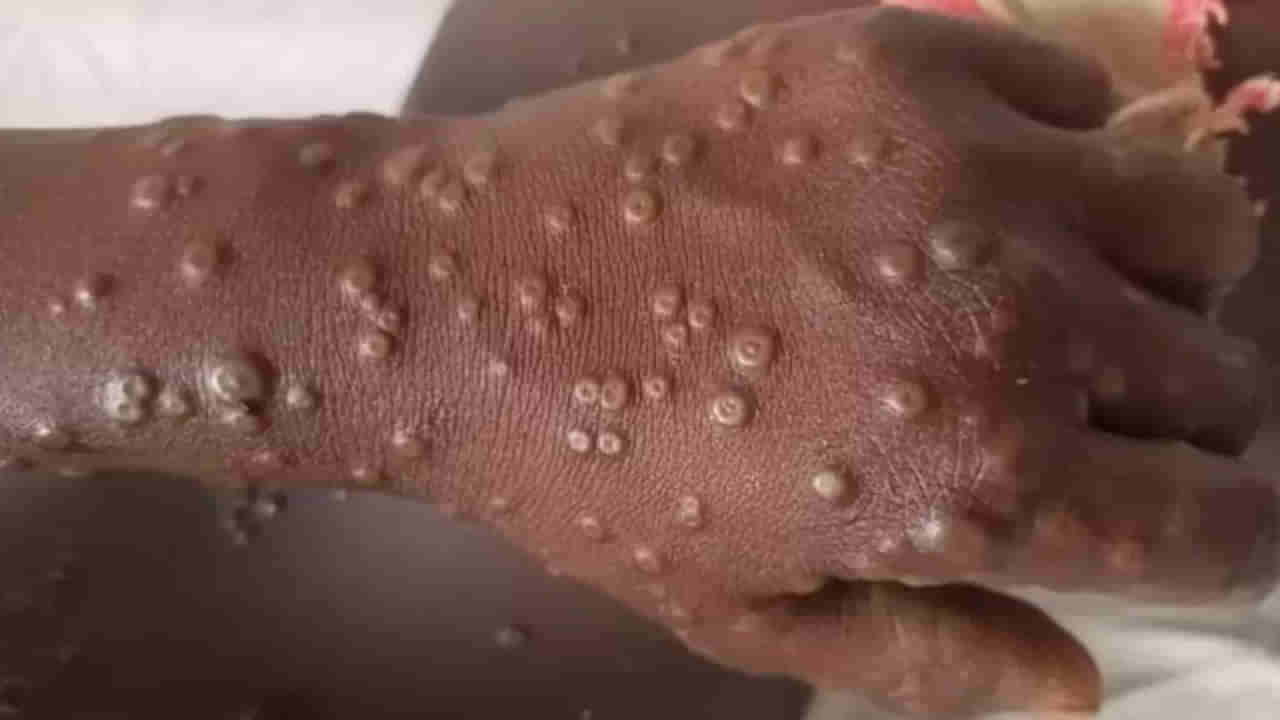 Monkeypox: వామ్మో.. రెండో కేసు నిర్ధారణ..! వేగంగా వ్యాపిస్తున్న మహమ్మారి.. వైద్యుల హెచ్చరిక