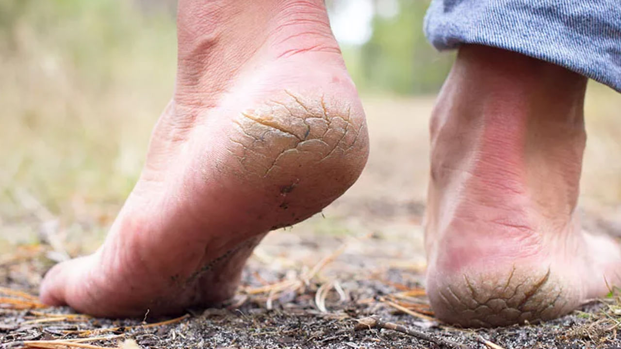 పగిలిన మడమల కోసం: చలికాలంలో కొంతమంది తరచుగా మడమల పగుళ్లతో బాధపడుతుంటారు. అటువంటి పరిస్థితిలో వాటిని నయం చేయడానికి పటిక చాలా ఉపయోగకరంగా ఉంటుంది. వేడి నీటిలో పటిక, ఉప్పు కలపాలి. ఆపై ఆ నీటిలో పాదాలను కొంత సమయం ఉంచాలి. ఈ ఇలా చేయడం వలన పగిలిన మడమలు మృదువుగా అవుతాయి. పగుల్లను నివారించడంలో కూడా సహాయపడుతుంది.