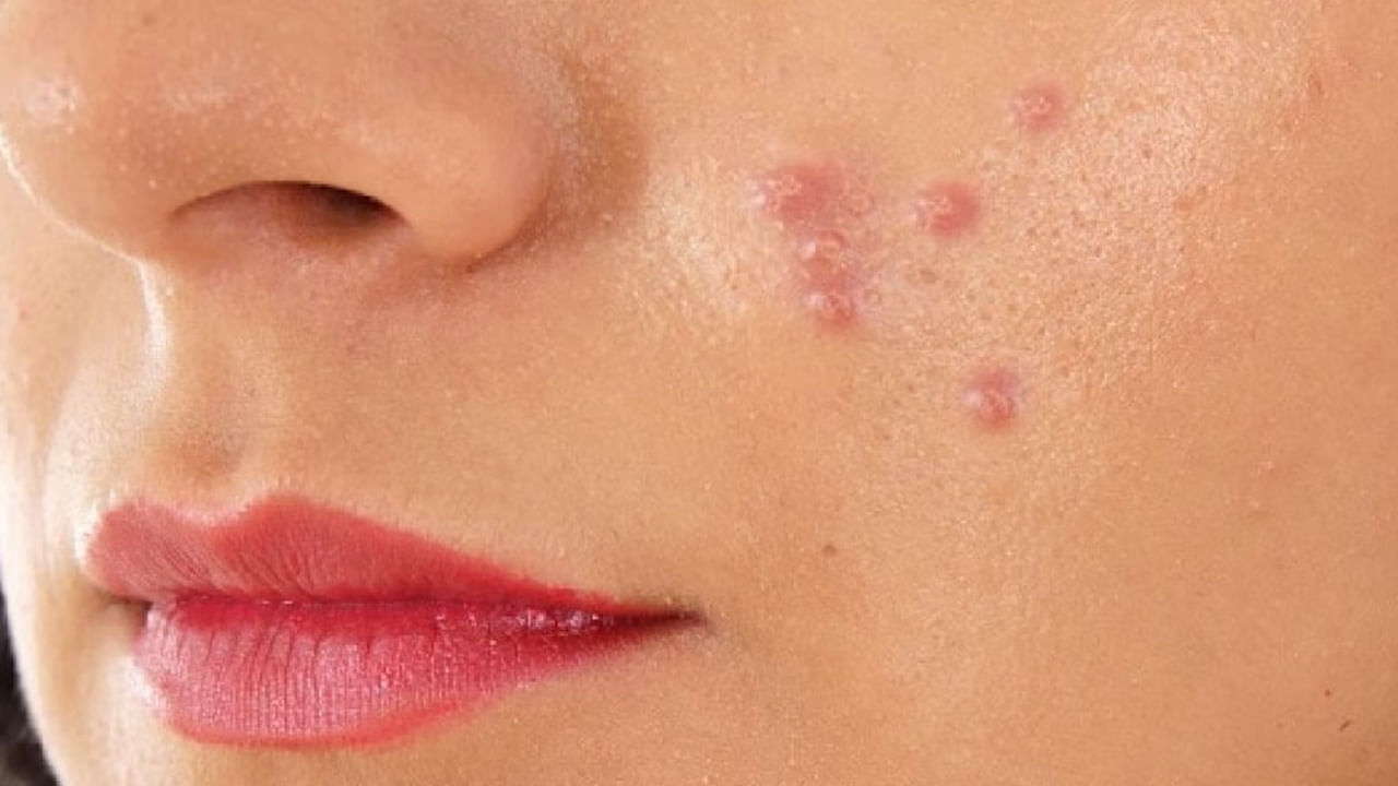 మొటిమలు: పటిక, ఉప్పు మొటిమలను తగ్గించడంలో కూడా సహాయపడతాయి. ఈ మిశ్రమం మొటిమలలోని బ్యాక్టీరియాను తొలగిస్తుంది. చర్మాన్ని శుభ్రపరుస్తుంది. ఇందుకోసం పటిక, ఉప్పు కలిపి పేస్టులా చేసి మొటిమలు, మచ్చలు ఉన్న ప్రాంతాల్లో అప్లై చేసి 10-15 నిమిషాల తర్వాత శుభ్రం చేయండి.