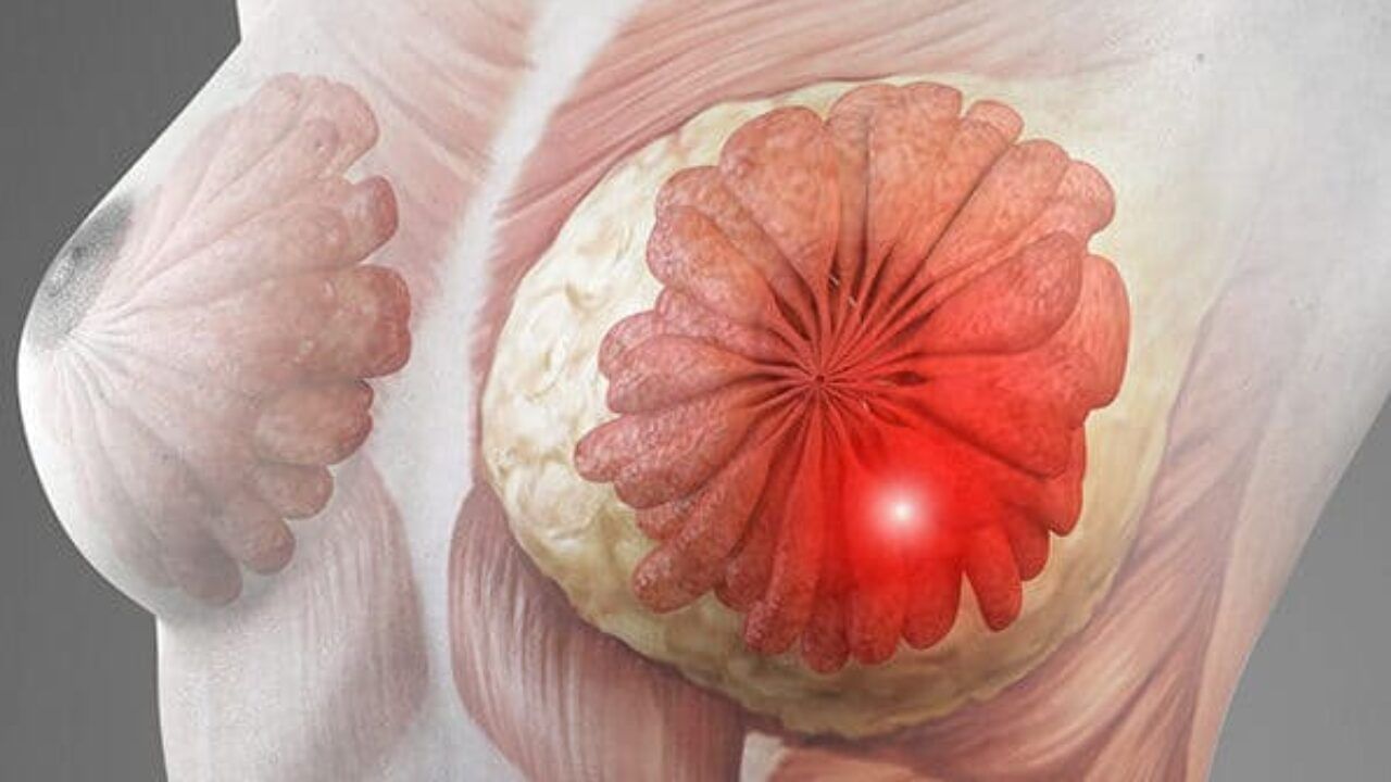 బ్రెస్ట్ క్యాన్సర్ ఉంటే నిపుల్స్ నుంచి.. తెలుపు, పసుపు, ఎరుపు రంగుల్లో ద్రవం అనేది బయటకు వస్తుంది. కాలర్ బోన్స్, చంకల్లో ఉండే లింఫ్ గ్రంథుల్లో మార్పులు వచ్చి.. వాపులు కనిపిస్తాయి. చిన్న లక్షణాలే గుర్తిస్తే త్వరగా ఈ సమస్య నుంచి బయట పడొచ్చు.
(NOTE: ఇందులోని అంశాలు కేవలం అవగాహన కోసం మాత్రమే. నిపుణులు అందించిన సమాచారం ప్రకారం ఇక్కడ తెలియజేయడమైనది. ఆరోగ్యరీత్యా ఎలాంటి సమస్యలు ఉన్నా వైద్య నిపుణుల్ని సంప్రదించడం మేలు.)