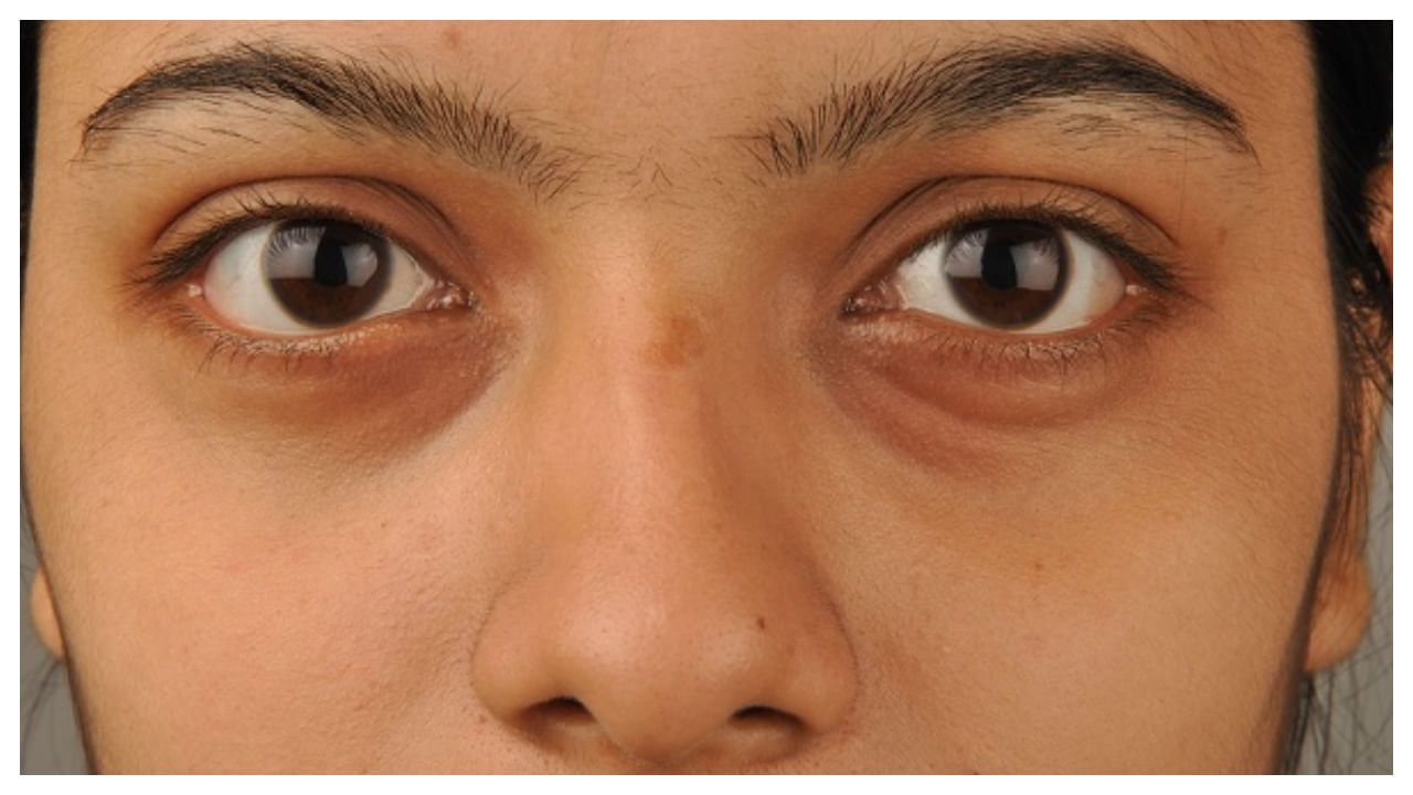 Swelling Eyes: కళ్లు ఉబ్బిపోయి ఇబ్బంది పడుతున్నారా.. ఈ చిట్కాలతో రిలీఫ్ పొందండి!