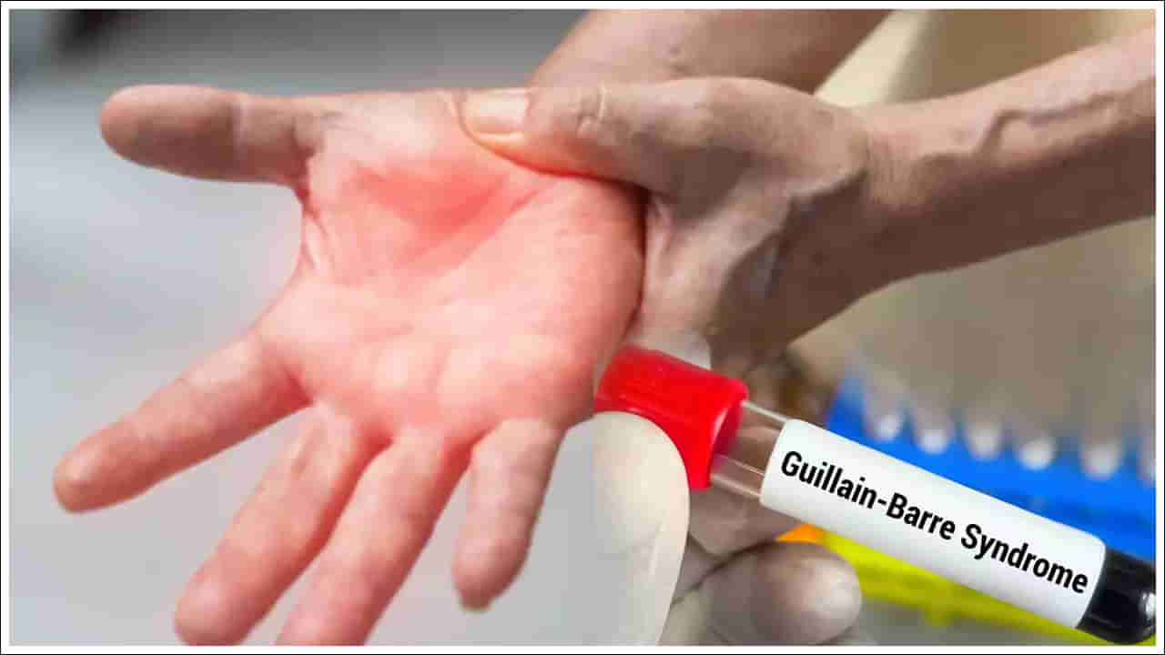 GBS Case: బిగ్‌ అలర్ట్‌.. తెలంగాణలో తొలి గులియన్‌ బారే సిండ్రోమ్‌ కేసు నమోదు!
