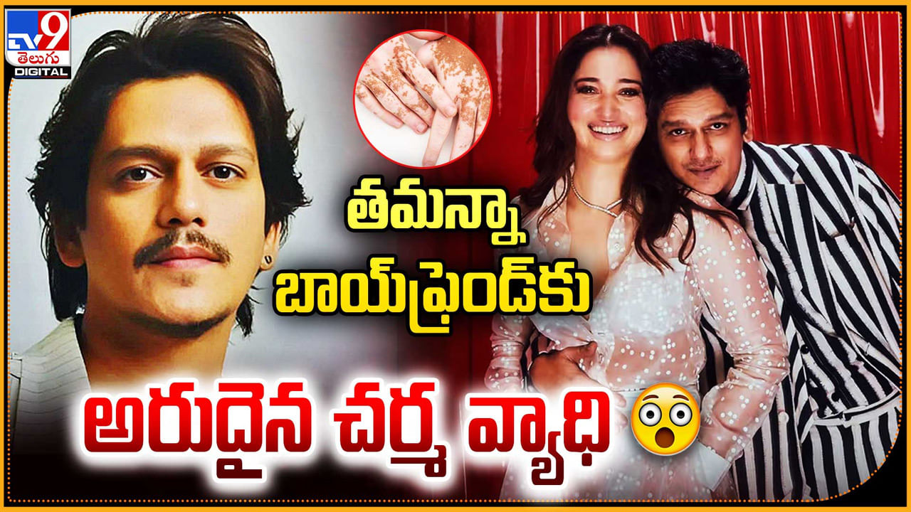 Vijay Varma: తమన్నా బాయ్‌ఫ్రెండ్‌ విజయ్ వర్మకు అరుదైన చర్మ వ్యాధి.! వీడియో చూస్తే షాకే.!