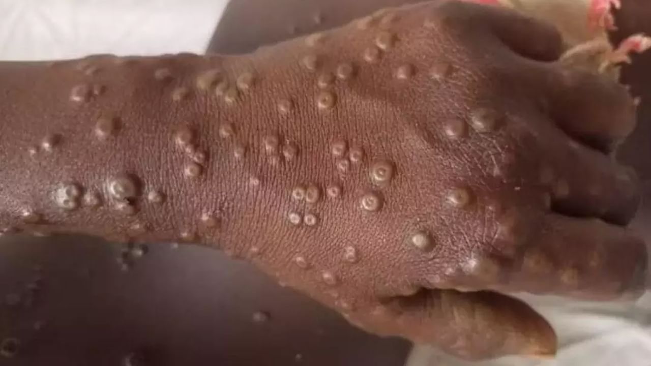 Mpox Cases: మళ్లీ విజృంభిస్తున్న మంకీ ఫాక్స్‌ వైరస్‌.. బెంగళూరులో తొలి కేసు నమోదు