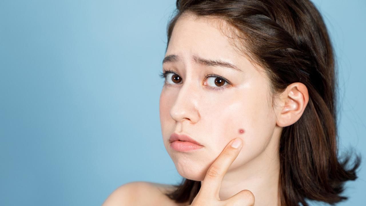 Pimple Remedies 3