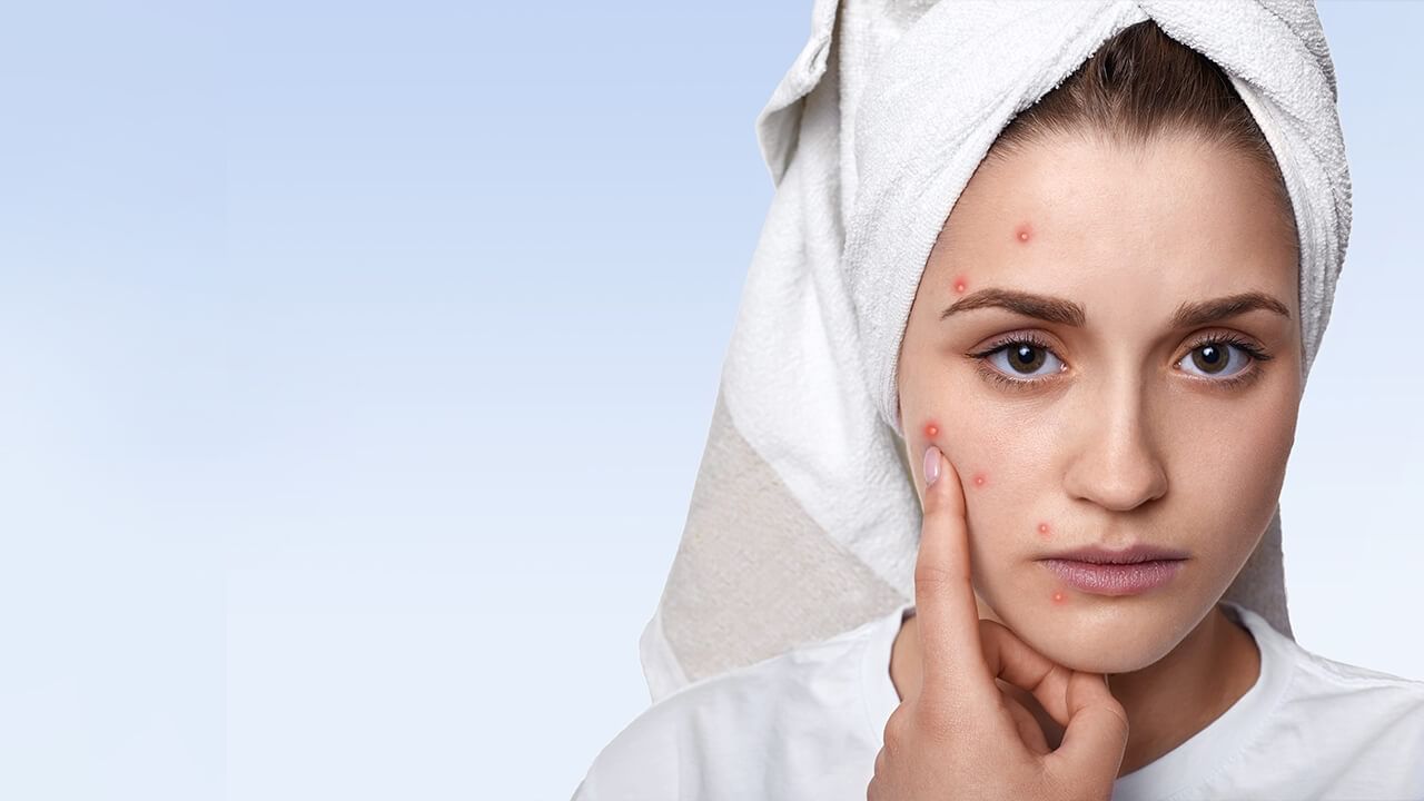 Pimple Remedies: మొటిమలను కంట్రోల్ చేసే అద్భుతమైన చిట్కాలు..