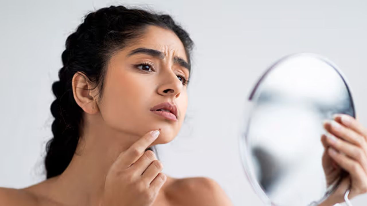 Pimple Remedies 5
