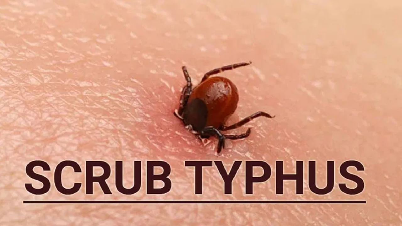 Scrub Typhus: మళ్లీ భయంభయం.. దడ పుట్టిస్తున్న స్క్రబ్ టైఫస్ వ్యాధి! ఎలా వ్యాపిస్తుందో తెలుసా..