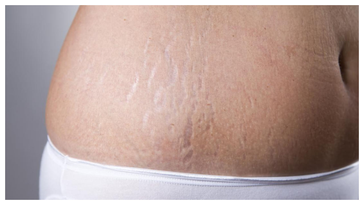 ఈ మార్క్స్ పోగొట్టుకోవడం కోసం అనేక క్రీములు వంటివి ఉపయోగిస్తూ ఉంటారు. ప్రెగ్నెన్సీ సమయంలో లేడీస్ పొట్ట అనేది ముందుకు సాగుతుంది. దీని కారణంగా ఆడవాళ్ల పొట్టపై గీతలు అనేవి పడతాయి. 
