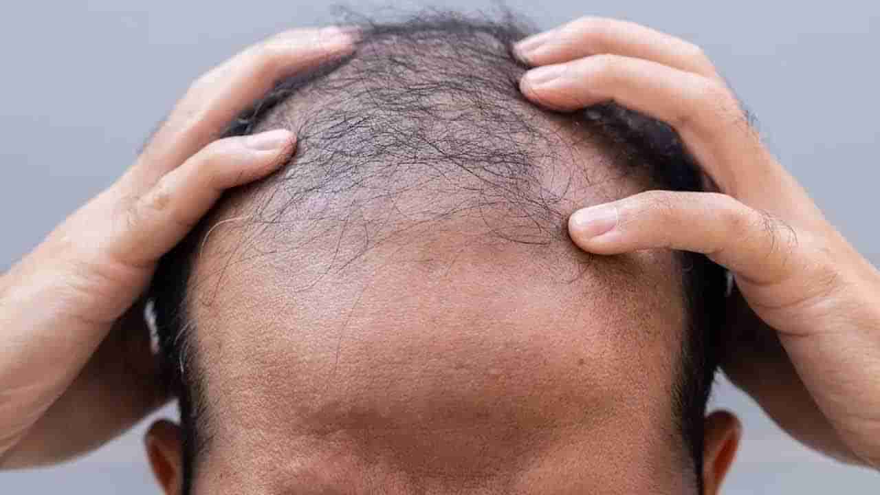 ఓరి దేవుడా.. రేషన్ గోధుమలతో వేగంగా బట్ట తల! వింత వ్యాధి కలకలం..