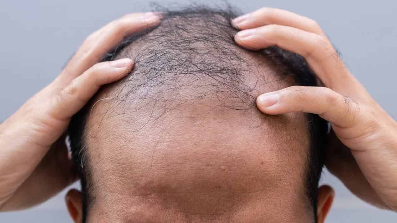 ఓరి దేవుడా.. రేషన్ గోధుమలతో వేగంగా బట్ట తల! వింత వ్యాధి కలకలం..