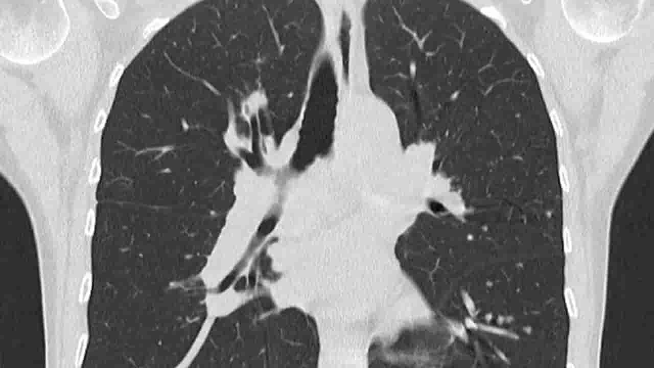 Hyderabad: విపరీతమైన దగ్గు, బరువు తగ్గిపోతున్నాడు.. ఆస్పత్రికి వెళ్లగా.. స్కాన్ చేసిన డాక్టర్లు షాక్