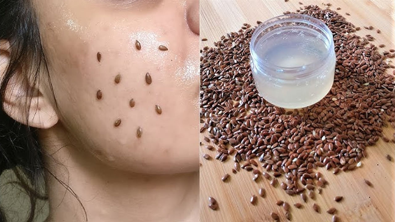 అవిసె గింజలలోని ఆల్ఫా-లినోలెనిక్ ఆమ్లం పురుషులలో బట్టతలని ఎదుర్కోవడంలో సహాయపడుతుంది. అవిసె గింజల్లో ఒమేగా-3 కొవ్వు ఆమ్లాలు ఉంటాయి. ఇవి జుట్టు స్థితిస్థాపకతను పెంచుతాయి. జుట్టు విరిగిపోవడాన్ని నివారిస్తాయి. ఫోలికల్స్‌ను బలోపేతం చేస్తాయి.