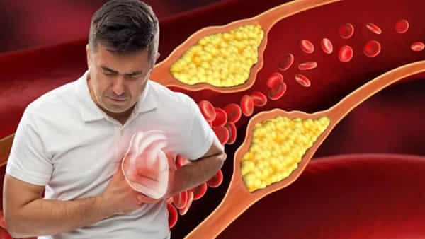 Health Tips: అధిక కొలెస్ట్రాల్ గుండె ఆరోగ్యానికి ప్రమాదకరమా..?
