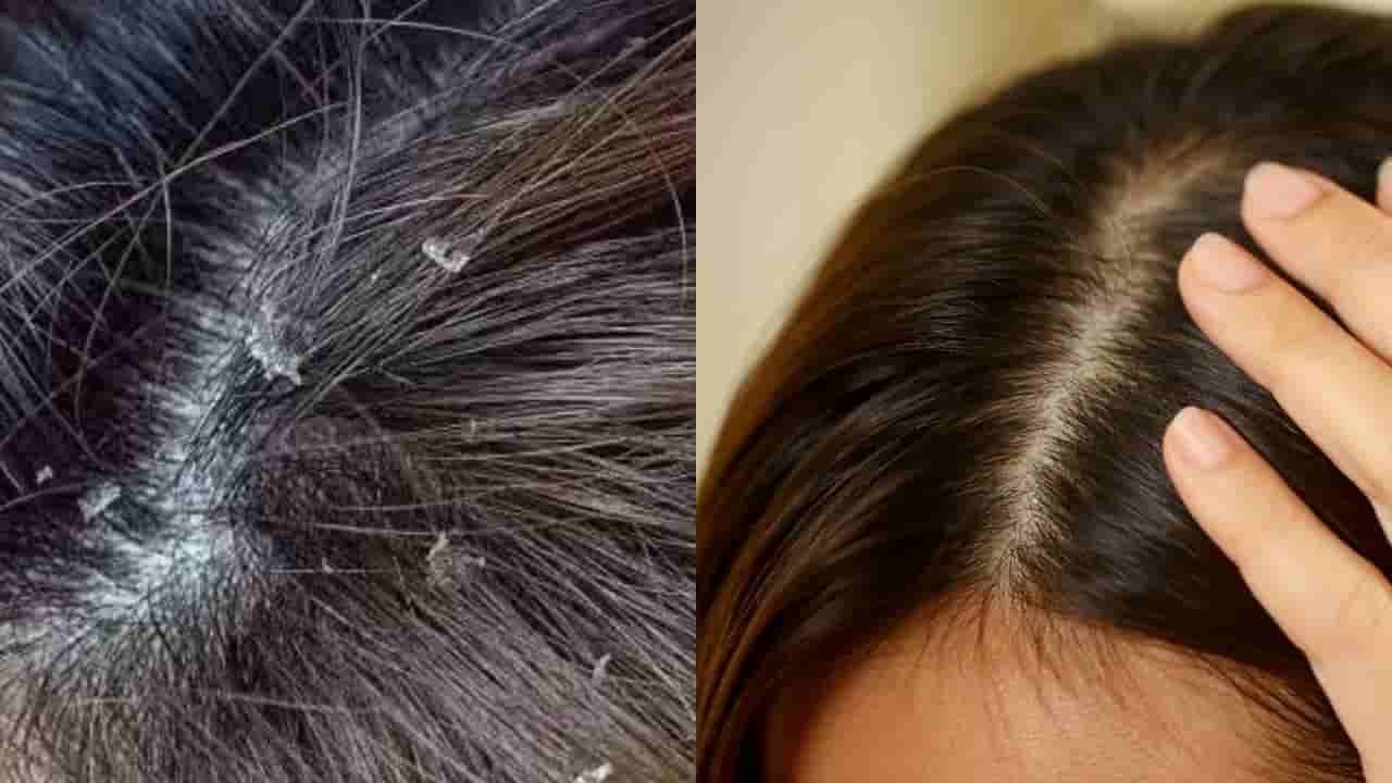 చుండ్రు సమస్యతో ఇబ్బంది పడుతున్నారా..? అయితే సింపుల్ హోమ్ రెమెడీస్తో గుడ్బై చెప్పండి..!