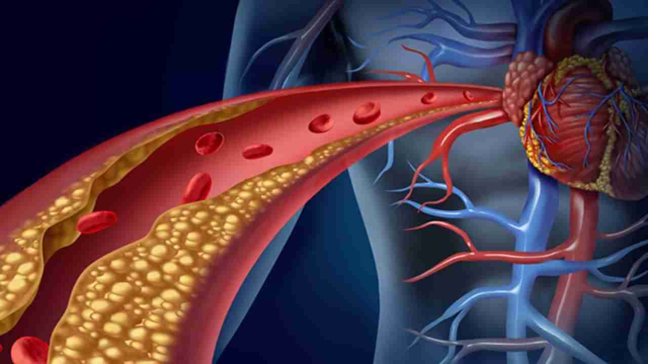 అధిక కొలెస్ట్రాల్ వల్ల గుండె ఆరోగ్యానికి ముప్పు..! వైద్య నిపుణులు ఏం చెబుతున్నారంటే..!