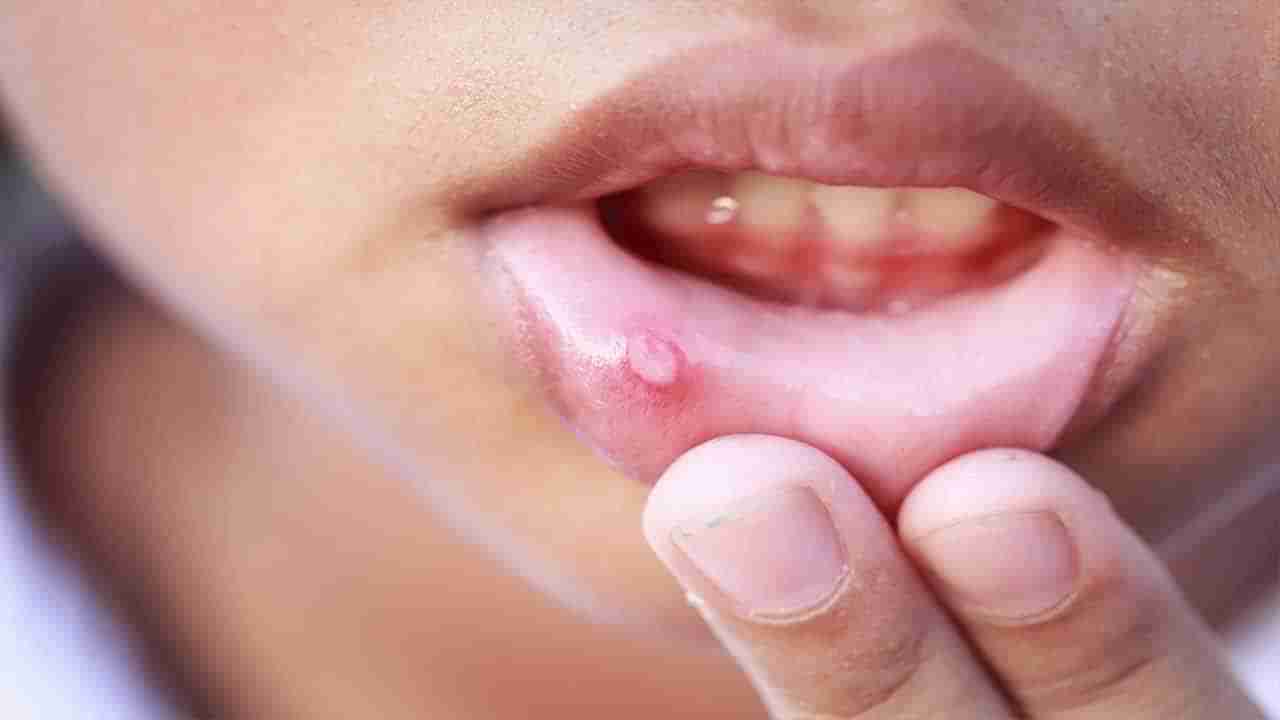 Mouth Ulcers: నోటి అల్సర్లను తక్కువగా అంచనావేయొద్దు.. ఇది ప్రమాదకర వ్యాధులకు ముందస్తు సంకేతం