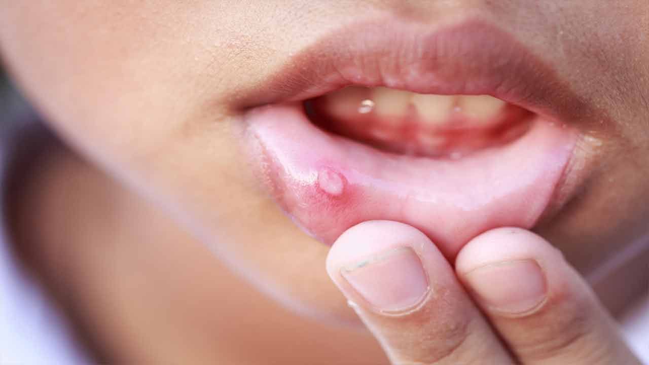 Mouth Ulcers: నోటి అల్సర్లను తక్కువగా అంచనావేయొద్దు.. ఇది ప్రమాదకర వ్యాధులకు ముందస్తు సంకేతం