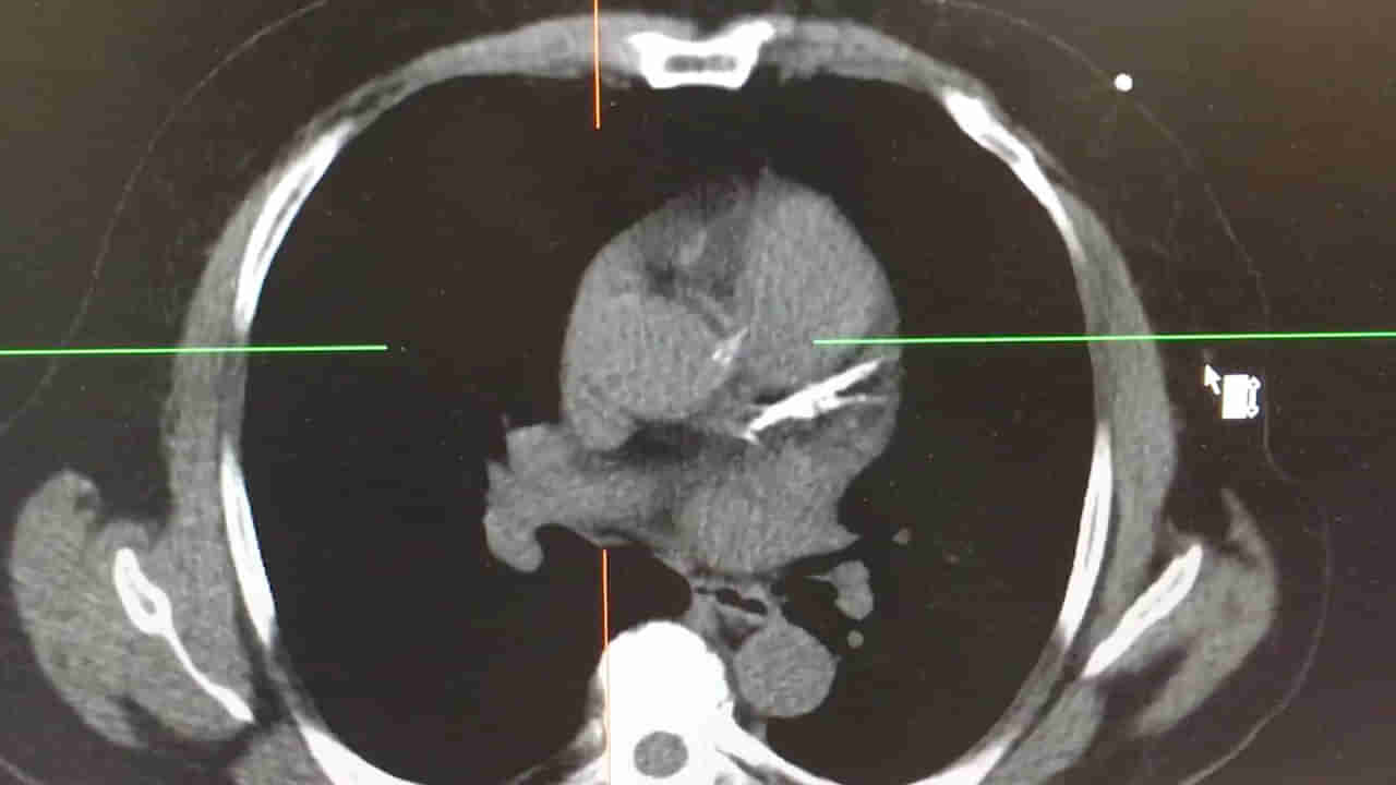 Viral: నెయిల్ పాలిష్ వేసుకుంటూ స్పృహతప్పిన చిన్నారి.. CT స్కాన్ చేయగా