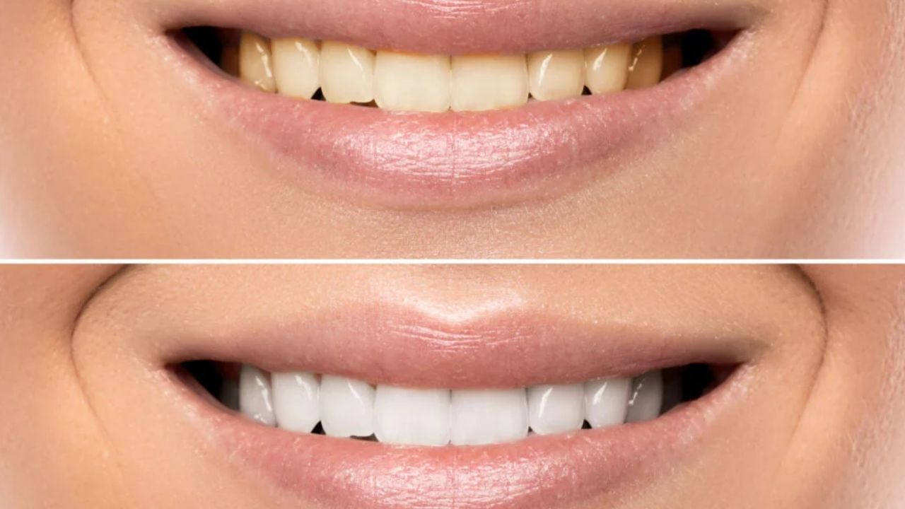 ఆరోగ్యకరమైన దంతాలను కాపాడుకోవడానికి కొన్ని ముఖ్యమైన అలవాట్లు పాటించడం అవసరం. ప్రతిరోజూ ఉదయం లేవగానే, రాత్రి పడుకునే ముందు తప్పనిసరిగా బ్రష్ చేయాలి. మంచి ఫ్లోరైడ్ టూత్‌పేస్ట్ ఉపయోగించడం ద్వారా దంతాల గట్టిపాటుతనాన్ని మెరుగుపర్చుకోవచ్చు. బ్రష్ చేసిన తర్వాత మౌత్‌వాష్ ఉపయోగించడం నోటి శుభ్రతను కాపాడడానికి సహాయపడుతుంది. రోజూ టీ, కాఫీ లాంటి డ్రింక్ లు తాగిన వెంటనే గోరువెచ్చని నీటితో పుక్కిలించడం మరకలు ఏర్పడకుండా ఉండటానికి మంచిది. ఇలా చేయడం వల్ల దంతాలను ఆరోగ్యంగా ఉంచుకోవచ్చు.