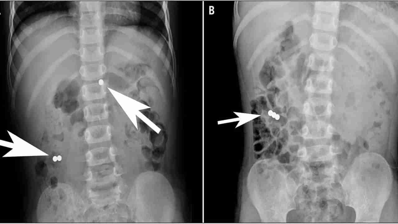 Viral: బాలిక కడుపులో చిత్రవిచిత్ర శబ్దాలు.. భయంతో ఆస్పత్రికి తీసుకెళ్లగా.. ఎక్స్‌రేలో
