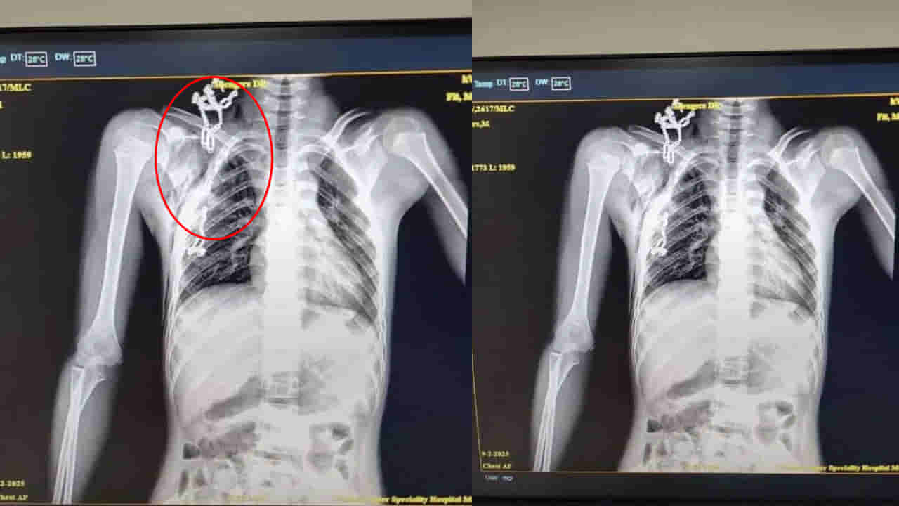 Viral: బాలుడు ఆడుకుంటుండగా నెత్తిపై పడ్డ కొబ్బరి మట్ట.. CT స్కాన్ చేయగా