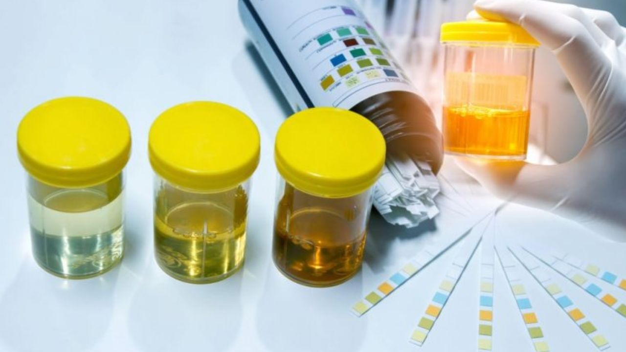 మీ మూత్రంలో నురుగు ఏర్పడుతుందా..? అయితే ఈ సమస్యలు ఉన్నట్టే..! వైద్య నిపుణులు ఏం చెబుతున్నారో తెలుసా..?